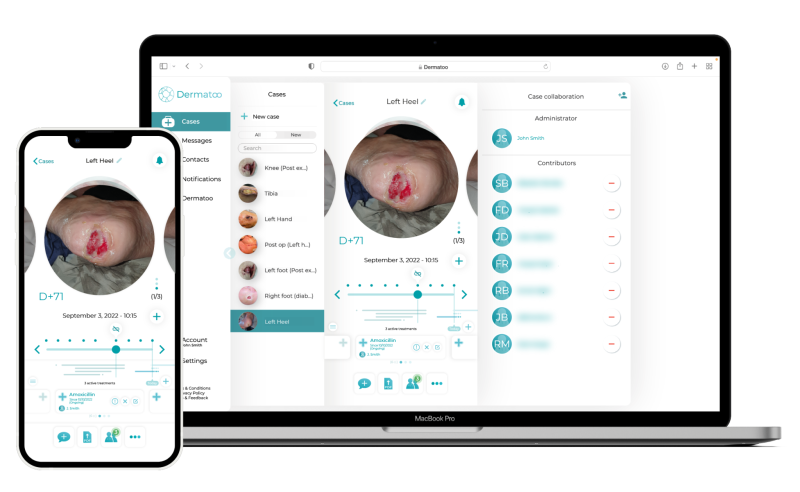 Dermatoo | Transformer la gestion opérationnelle des plaies chroniques